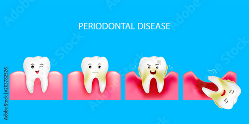 Step of periodontal disease. Healthy tooth and gingivitis. Dental care concept. Illustration isolated on blue background. photo