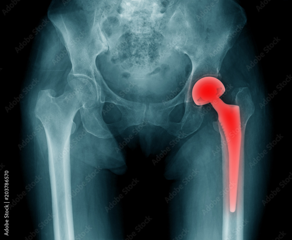 hip replacement xray, image of radiology hip arthroplasty Stock Photo Adobe Stock