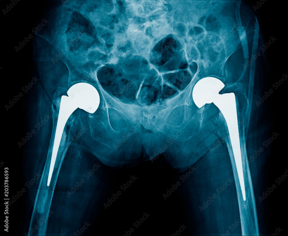x-ray bilateral hip replacement, post operation total hip arthroplasty both  side of old man Stock Photo