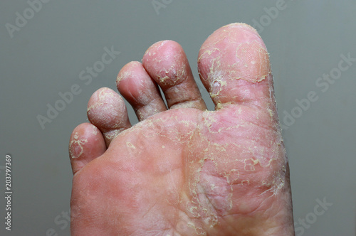 Athlete's foot - tinea pedis, fungal infection © chaipanya