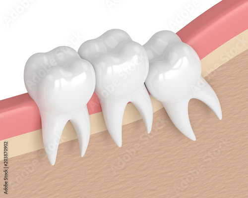 Canvastavla 3d render of teeth with wisdom crowding