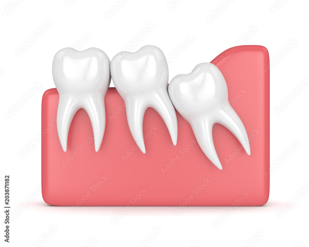3d render of teeth with wisdom crowding 3d render of teeth with wisdom crowding