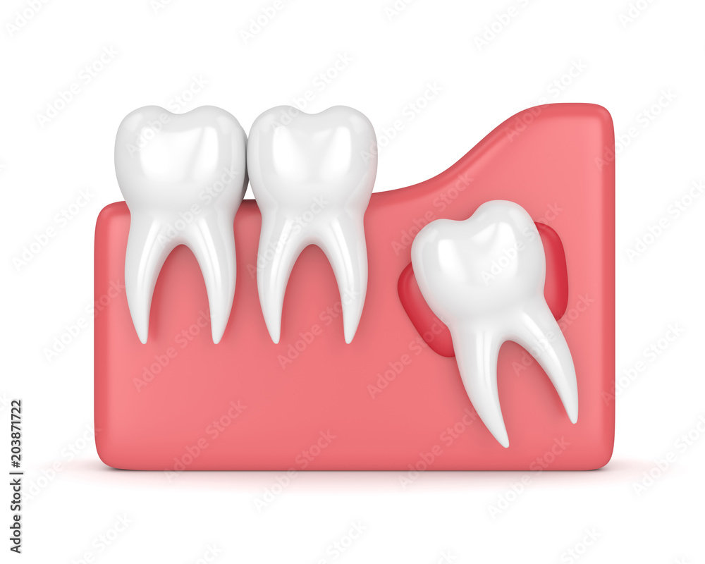 3d render of teeth with wisdom cyst 3d render of teeth with wisdom cyst