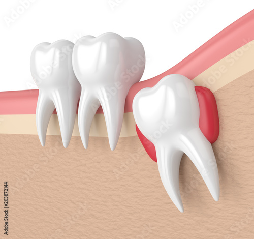 3d render of teeth with wisdom cyst
