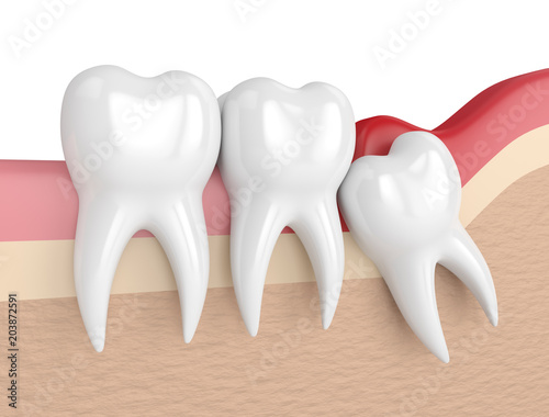 Canvastavla 3d render of  wisdom mesial impaction with pericoronitis