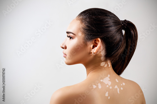 Portrait of beautiful woman with vitiligo. photo