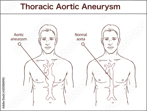vector illustration of a Abdominal aortic aneurysm