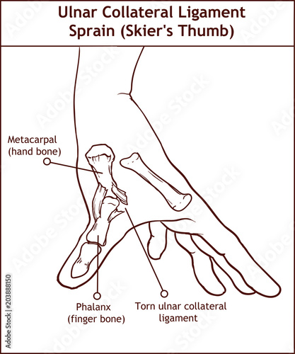 ULNAR COLLATERAL LIGAMENT SPRAIN