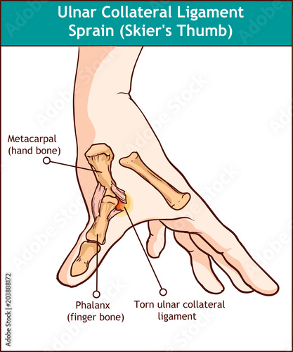 ULNAR COLLATERAL LIGAMENT SPRAIN