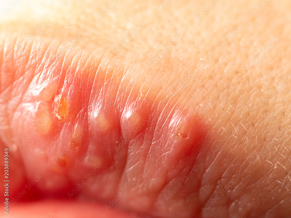 Fototapeta premium herpes on the lips