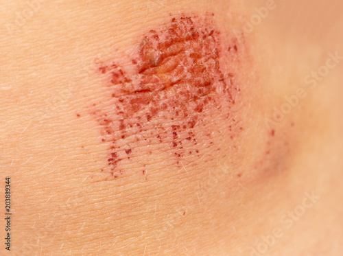 abrasion on the child's knee