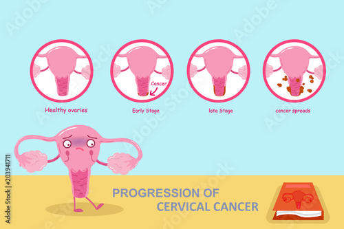 progression of cervical cancer
