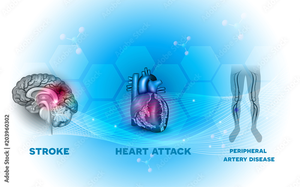 disease of blood vessels supplying the heart muscle