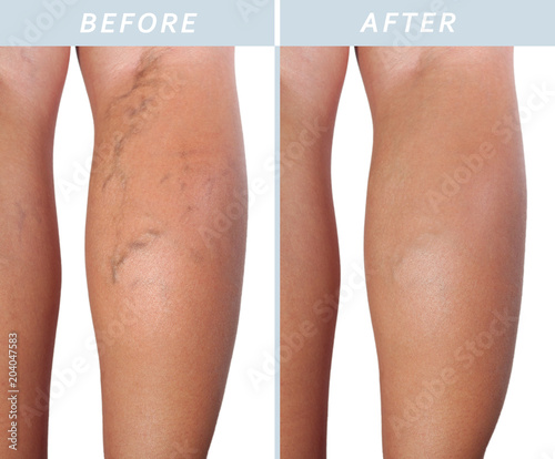 Foto Varicose veins on the legs after and before treatment
