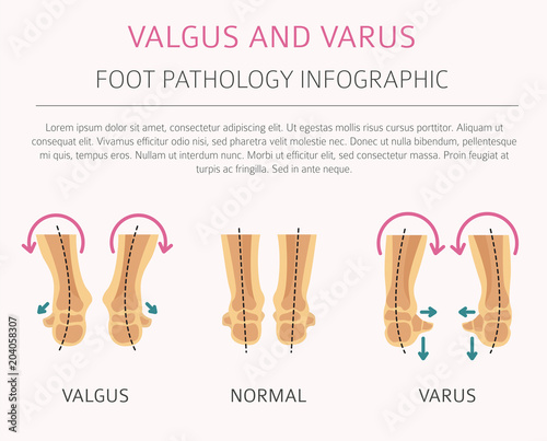 Foot deformation as medical desease infographic. Valgus and varus defect