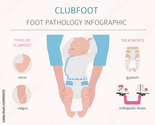 Foot deformation, medical desease infographic. Clubfoot defect