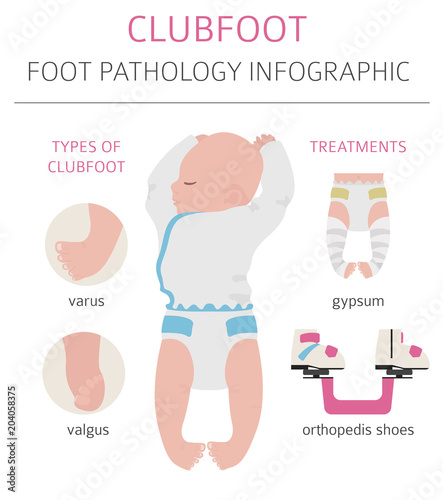 Foot deformation, medical desease infographic. Clubfoot defect