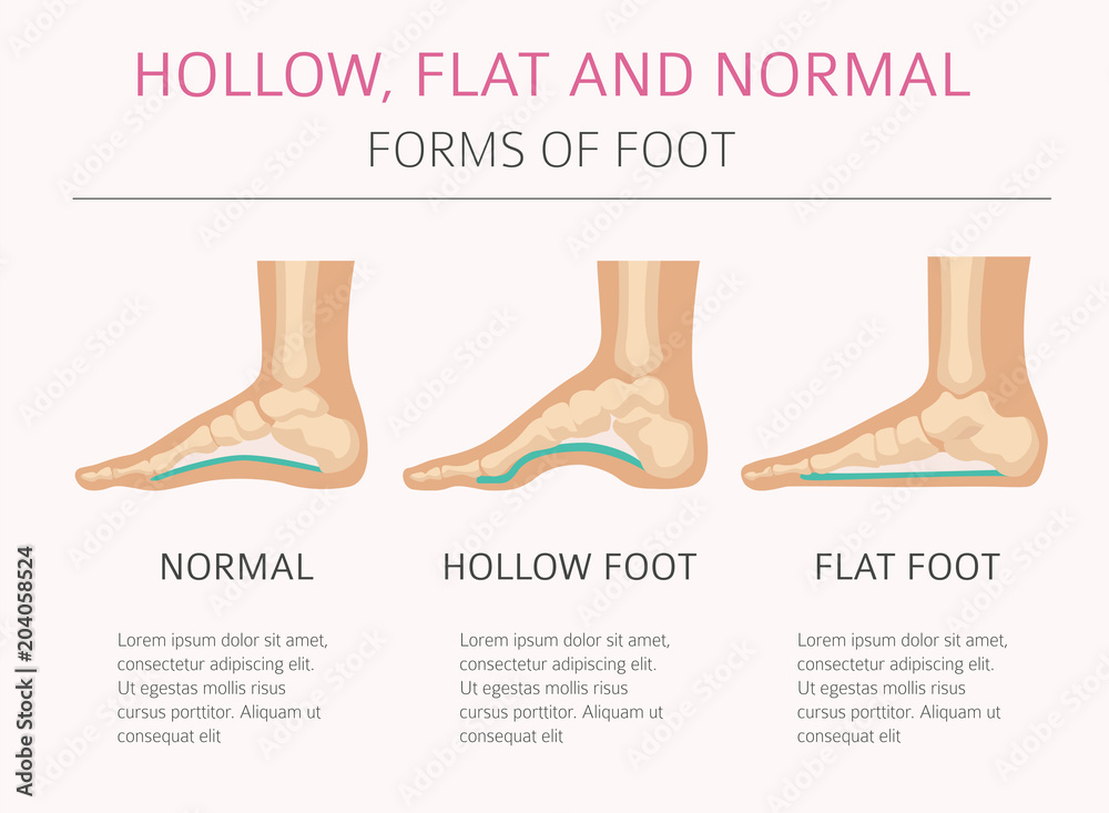 Foot deformation types, medical desease infographic. Hollow, flat and