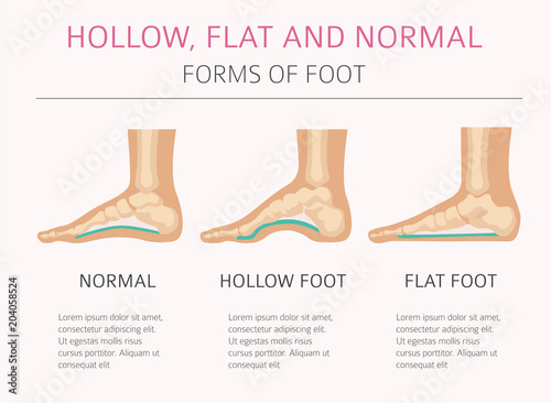 Foot deformation types, medical desease infographic. Hollow, flat and normal foot