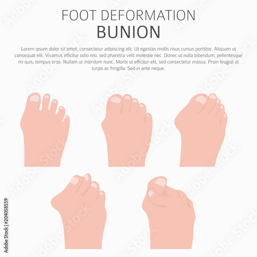 Foot deformation as medical desease infographic. Causes of bunion