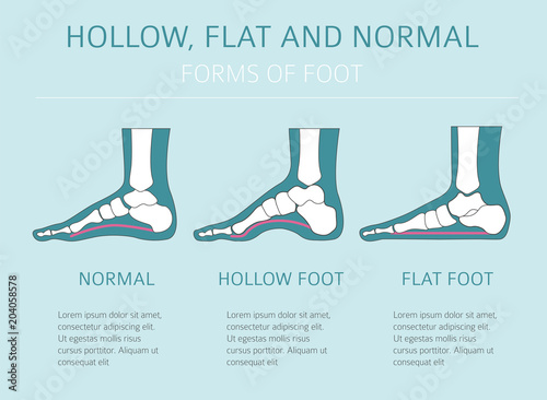 Foot deformation types,  medical desease infographic. Hollow, flat and normal foot
