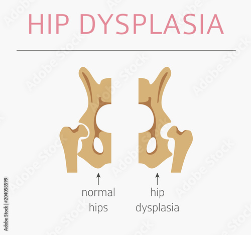Foot deformation types,  medical desease infographic. Hip dysplasia in children