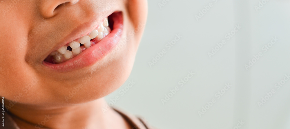 Little boy Show Broken teeth.boy with a Teeth broken and rotten Little boy Show Broken teeth.boy with a Teeth broken and rotten