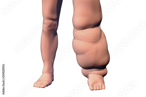 Leg of a person with elephantiasis, or lymphatic filariasis, 3D illustration. A disease caused by nematode worms Wuchereria bancrofti and other, transmitted by mosquito bite photo