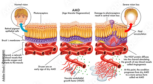 medical vector illustration of symptoms of AMD (age macular degeneration) photo