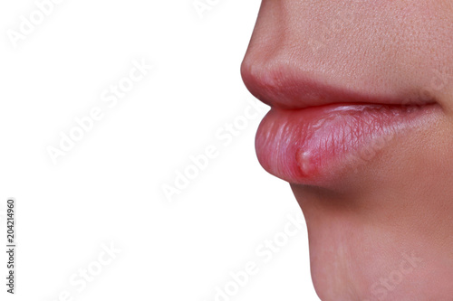 herpes on the lips photo