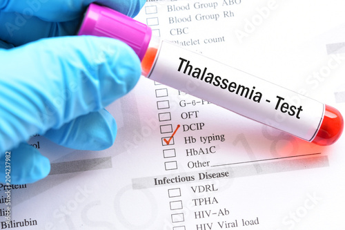 Blood sample for thalassemia test photo