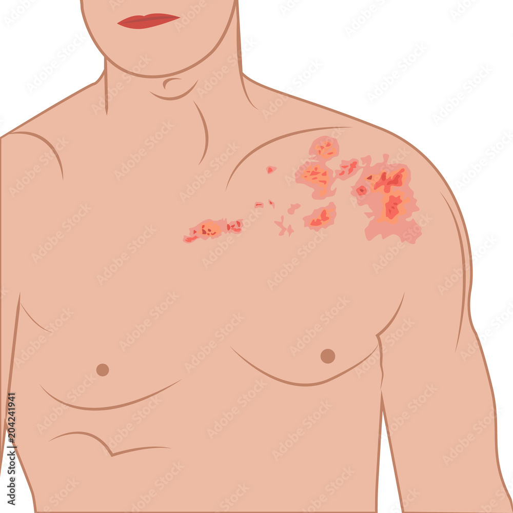 Shingles on a man body vector illustration Shingles on a man body vector illustration