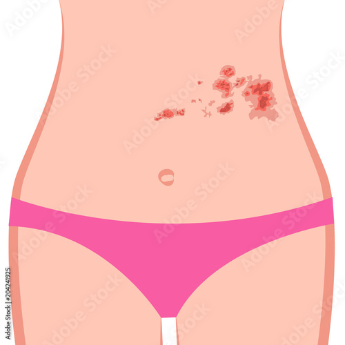 Shingles on a woman body vector illustration