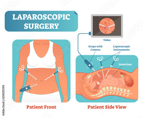 Laparoscopic surgery medical health care surgical procedure process, anatomical cross section vector illustration diagram.