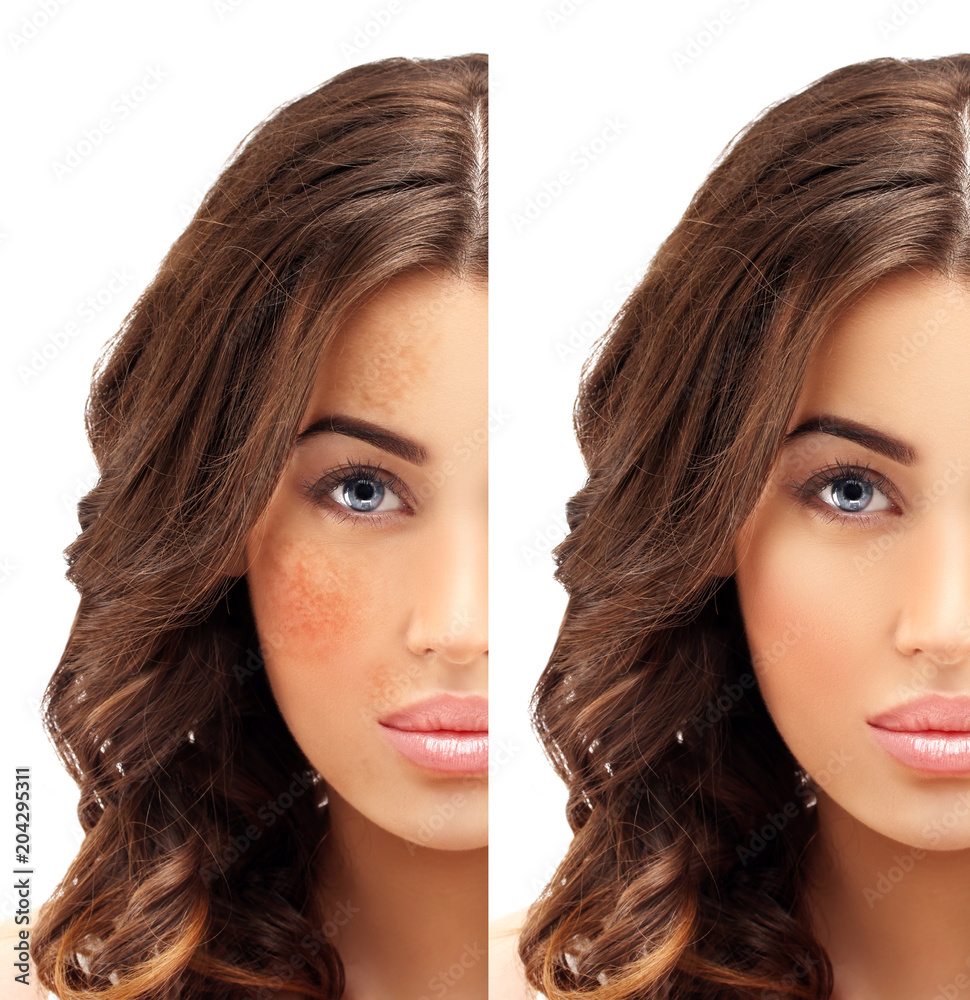 Dark spots, freckles,hyperpigmentation(melasma or chloasma)
