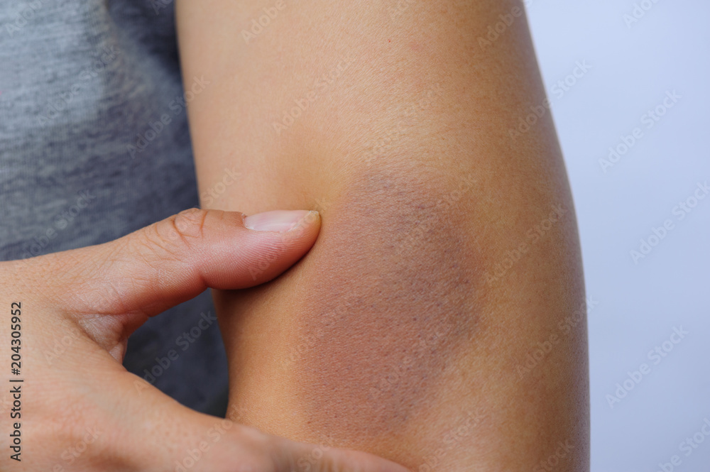 people with wounded arm holding in hand people with wounded arm holding in hand