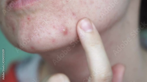 Closeup woman face with big ugly pimple. Acne teenager, skin problem person 4k