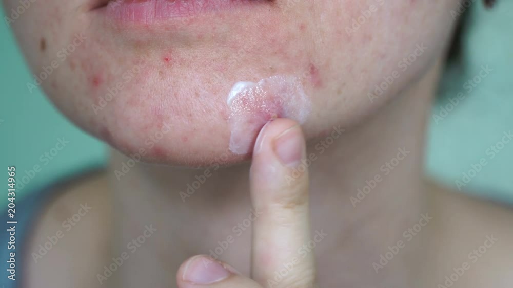 Woman with dermatology skin problem apply salve on big pimple at her face 4k