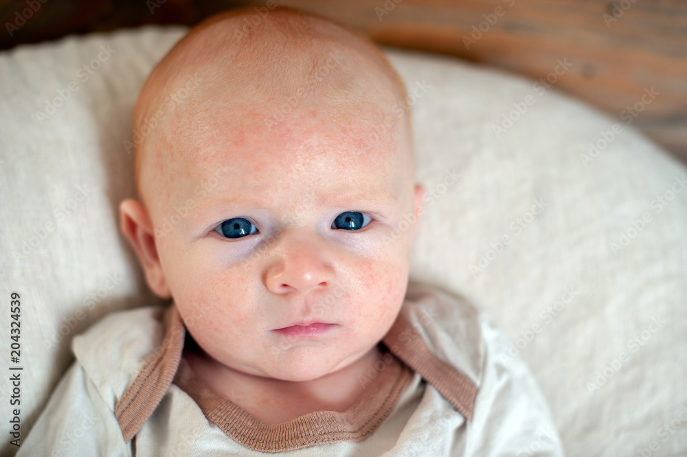Allergies, atopic dermatitis on the face of a baby Allergies, atopic dermatitis on the face of a baby