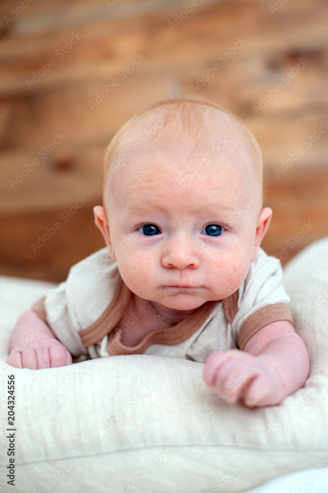 Allergies, atopic dermatitis on the face of a baby Allergies, atopic dermatitis on the face of a baby