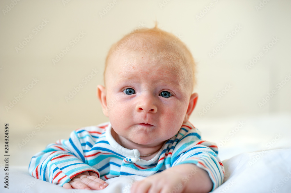 Allergies, atopic dermatitis on the face of a baby Allergies, atopic dermatitis on the face of a baby