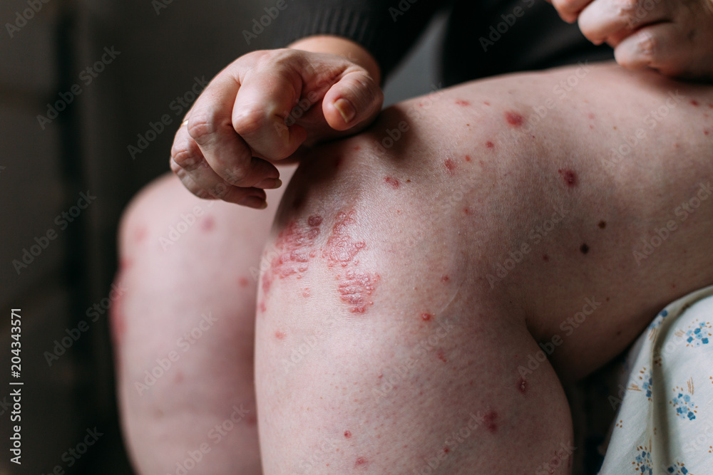 The problem with many people - eczema on hand. Lifestyle background. Woman itchind skin.