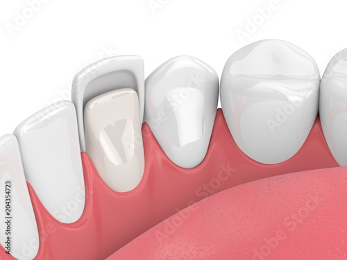 3d render of teeth with veneer photo