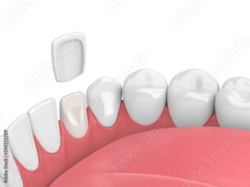 3d render of teeth with veneer