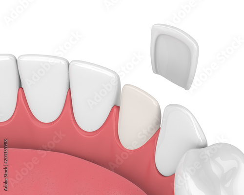 3d render of teeth with veneer