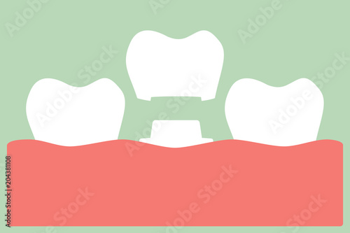 dental crown, installation process and change of teeth