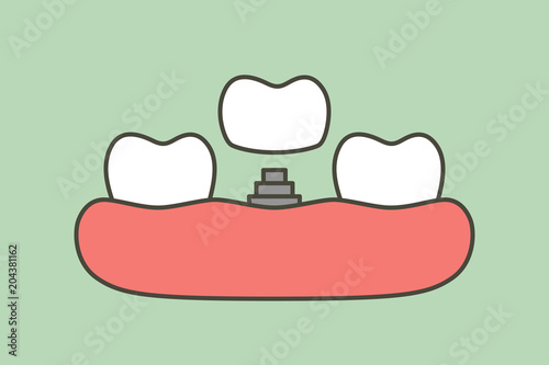 tooth implant, installation process and change new root for teeth