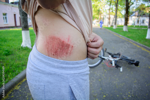 young male athlete injured his back and elbow after falling off a bicycle. Bicycle accident photo