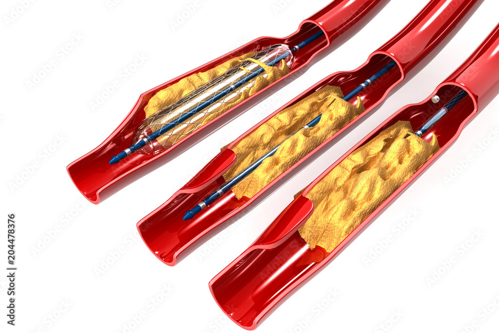 Balloon Expandable Stent. Anatomical concept Stock Illustration | Adobe  Stock