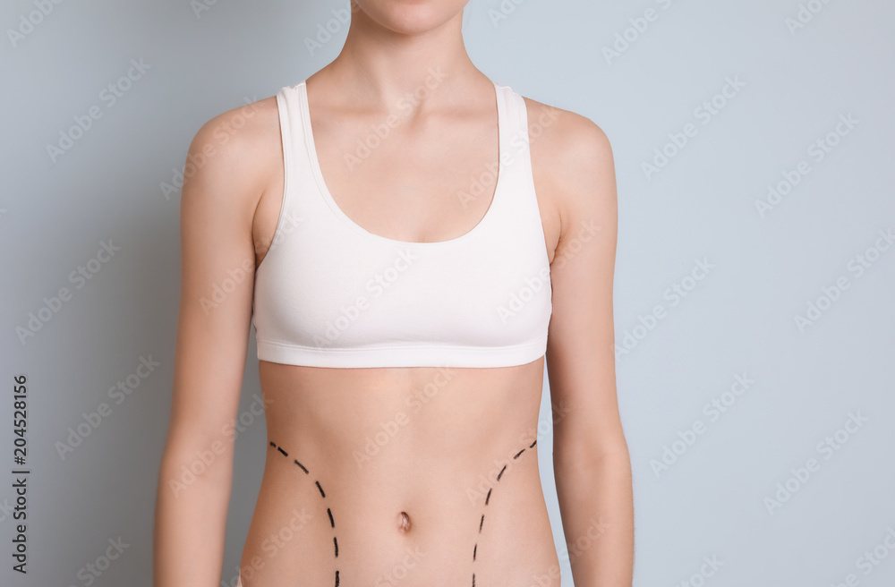 Young woman with marks on belly for cosmetic surgery operation against color background